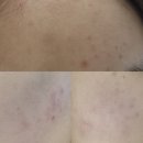 유메이 | [서울/노원] 내돈내산 노원 피부과 유메이비 피부과 여드름 케어 후기 (네오빔+PDT)