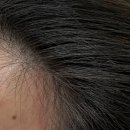 라인스포츠센타 | 영등포 두피관리/ 모다스튜디오에서 M자 헤어라인 교정 받은 후기