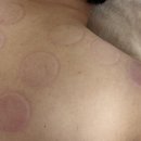 대건의집 | 집에서 간편하게 사용하는 부항기 추천, 남편 허리마사지 해준 후기 (대건부항 수동식부항기)