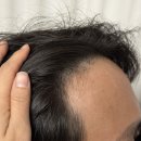 영메디케어 | 여보, 머리가 왜 이렇게 비어 보여? 대만족한 노비어 바르는 흑채 후기!