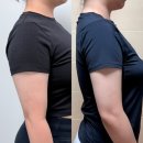 라인정보 | 수원 팔뚝살빼기 예신 다이어트 지방추출주사 후관리 가격정보 라인변화 후기