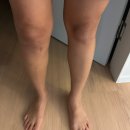 십자인대 수술 후 무릎 유착박리 수술 후기 (올바른 서울 병원 조재호원장님)