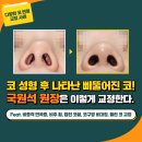 국원석성형외과의원 | 홍대성형외과 코재수술후기로 보는 변화