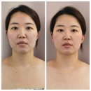 백혜진피부연구소 | 사하피부관리 두골비윤곽 백혜진피부연구소 웨딩관리받은 후기