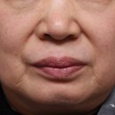 합정고려의원 | 합정역피부과 울쎄라 리프팅+레디어스 스킨부스터 후기 | 티 안나는 피부관리 추천