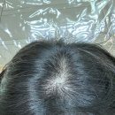 베스트원의원 | 멘토의원 탈모 치료 2년차 최종 후기 ver.3 리제네라액티바