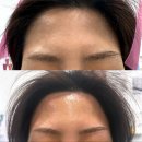 진헤어�� | 상암동왁싱 지봄뷰티 눈썹 헤어라인 왁싱받고 밝아진 후기