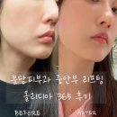 365부분 | 분당피부과 올리디아 365 콜라겐부스터 만족 후기 깊은 주름과 볼패임 고민이라면 추천