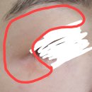 열감홍조 신경성 주사피부 정신과약 한달차 후기/다른정신과 약이랑 비교 ssri snri 둘 중 나한테 맞는것