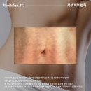 파인웰스 | 뉴스킨 웰스파 효과? 출산후 튼살/ 늘어난 뱃살관리 추천!