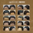 닥터안헤어플란트의원 | 10년은 젊어지는 닥터안 모발이식 수술후기