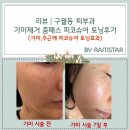 곧바로병원 | 리뷰│인천구월동피부과 추천 기미제거 줌패스 피코슈어토닝 효과 후기