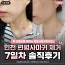 포메디 | 인천 편평사마귀 제거 후기 🤍 포메디한의원 솔직후기