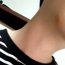 안산미드림 | 안산 미드림피부과에서 점제거 후기 (협찬×)