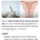 축복덩어리 | 내가 기억하려고 쓰는 자궁선근증 인간의 미레나 시술 후기