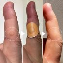 신신약국 | 손가락 티눈 사마귀 신신 티눈 밴드 제거 후기_ 초기 손쉽게 제거 노하우 공유!