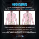 김포도수치료 척추측만증 자가진단, 원인을 파악 후 교정 이미지