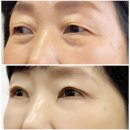 엄마의 중년눈성형 눈썹하거상/상안검수술/하안검수술후기 (하니성형외과/수술 한달차)