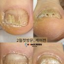 무좀발톱|내성발톱|파고드는발톱|변색발톱“오로지푸스 충남논산점에서 케어해 드릴게요!”*리무브후기*