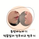 바노바기의원 동탄 | 동탄 턱끝필러 바노바기의원 전후비교! [솔직 후기 및 가격]