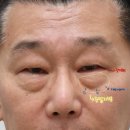 리미트성형외과의원 | 인천하안검 송도성형외과 ㅣ 성형외과전문의 하안검 부작용없이 안전하게 (feat.리미트성형외과)