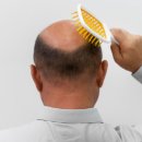 클라스코인 | 탈모 치료제 신약 클라스코테론, 게임 체인저가 될까?..현대약품 주가 급등