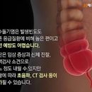 급성 맹장염 초기 맹장 (급성충수염, 남자 여자 맹장위치 역할 터졌을때) 이미지