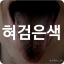 2002반점 | 혀검은색 혓바닥 반점 착색 돌기 손상 전신 질환 위생