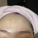 동그라미한의원 | 대구 한의원 편평사마귀 내돈내산 제거 후기