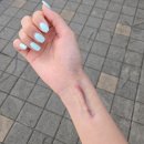 소예피부과의원 | 손목 골절 수술 흉터 켈로이드 흉터 치료 [위례 피부과/소예의원]