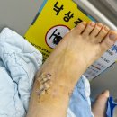 생생병원 | 부천 소사본동 생생병원 인대파열 수술후 입원후기 (식사, 간병, 실비보험청구까지)