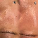 세븐일레븐 춘천영서뷰티점 | 모공 탄력 개선엔 써마지! 1회 시술 전후 차이 (유해채 에스테틱)