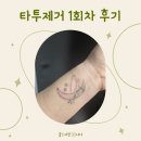 솔트약국 | 청담동 병원에서 타투제거 문신제거 한 후기 (1회차)