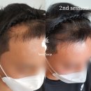 호담재한의원 | 미아두피커버 새로이숲 후기