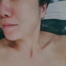 고은선한의원 | 논현동피부관리 안다다씨 악건성피부 물방울리프팅 후기