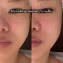 렛미인 - 연수구 | [대구윤곽관리/동성로피부관리] 동성로 윤곽관리 받으며 피부 고민도 해결한 렛미인dearrest 솔직 후기