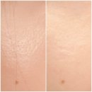 고랑포길 | 소프웨이브 효과 가격 공유! 잔주름 모공관리 도움되는 초음파리프팅