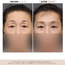 뷰리프성형외과의원 | 대전 이마거상 후기｜눈썹하거상·눈매교정·하안검까지 함께한 이유