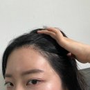 동글댕글 | 신사역 비절개 헤어라인 모발이식 한달,두달, 세달차 후기