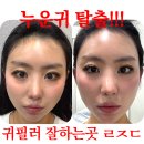 채움 | 압구정 피부과 귀필러 더채움 후기 맞춤시술 일주일후기