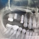 (주)이디임플란트 | 《문정동 치과, 만족스러운 임플란트 후기