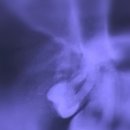 태릉씨티치과의원 | 군산 이루다치과 사랑니 발치 후기｜조촌동 치과 추천