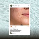 제이더블유신약(주) | 여드름 약국 연고: 에크논, 에스로반, 클리어틴 효과와 사용법 + 후기 &amp; 추천