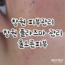 물오른피부 - 달서구 조암로 38 | 창원피부관리 물오른피부 플라즈마 후기