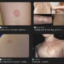 우보한의원 | 사타구니 백선 완치 말고 완화 후기 | 생활습관 &amp; 병원 &amp; 통풍 잘되는 속옷 추천