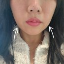 31140-5-40-8 | 브이로 레이저 40대 심부볼 민트실 리프팅 신사피부과 솔직후기