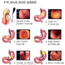 위암의 예방과 치료 이미지