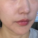 염산제일의원 | 압구정 루나의원 루비레이저 - 선생님이 말렸는데 내 맘대로 한 썰, 내돈내산, 솔직후기