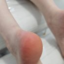 레푸스연신내점 | 불광 발각질 레푸스 연신내점 아기발 비포 애프터