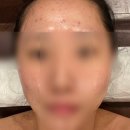 떡보의하루구미점 | 구미여드름관리_미노브에스테틱:AC 트리트먼트 비산동 여드름관리